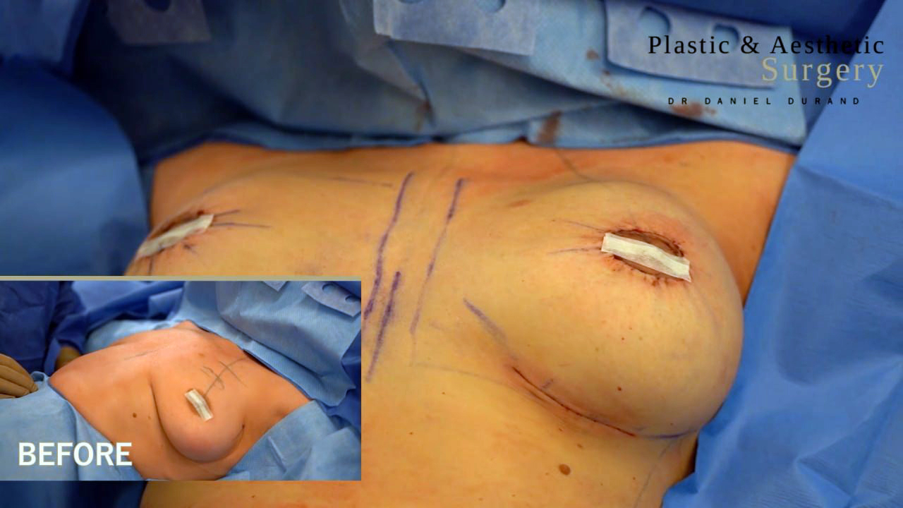 Breast Augmentation A cup to C cup - Montreal Board Certified Plastic  Surgeon Dr Daniel Durand