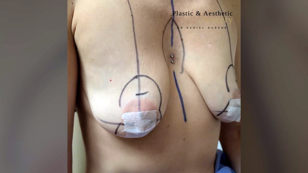 Breast Augmentation A cup to C cup - Montreal Board Certified Plastic  Surgeon Dr Daniel Durand