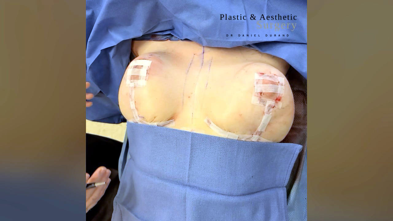 Breast Augmentation A cup to C cup - Montreal Board Certified Plastic  Surgeon Dr Daniel Durand