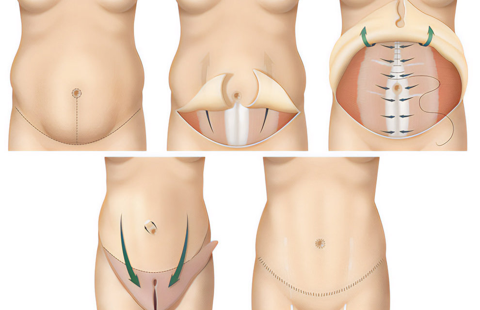 Tummy Tuck Dalton & Chattanooga - Abdominoplasty