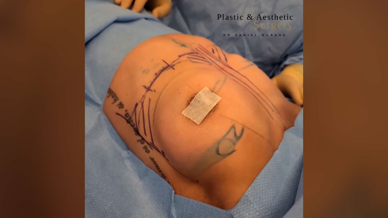 Breast Augmentation A cup to C cup - Montreal Board Certified Plastic  Surgeon Dr Daniel Durand